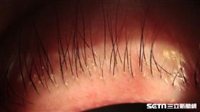 張女士睫毛常有白色屑屑，竟是毛囊蠕形螨蟲在睫毛根部蠕動。（圖／台北慈濟醫院提供）
