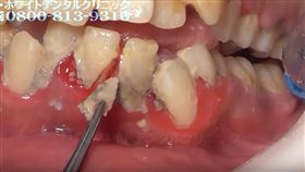 張嘴嚇死人！25歲女滿口結石　醫洗牙「鑽除爆血」超療癒
圖翻攝自
ザ・ホワイトデンタルクリニック YOUTUBE
