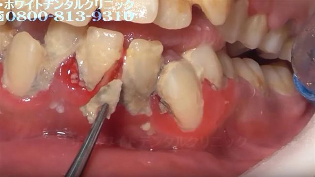 女滿口結石　洗牙「鑽除爆血」超療癒