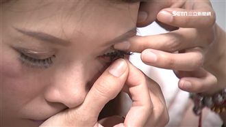 「變色片」遇高溫黏眼球　她硬拔傷眼