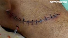 嚇人！男浴室滑倒遭磁磚割腿　10公分傷口竟染大便細菌（圖／豐原醫院提供）