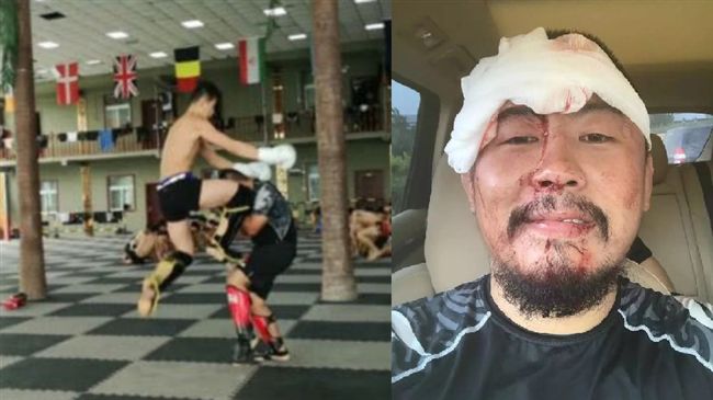 1打4！格鬥狂人遭頂膝爆頭縫26針