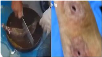 殺魚劃傷指甲！大叔手被蛀空…見恐怖黑洞