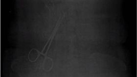 術後腹部痛不停　她安檢才知「腹部藏手術夾」！　圖／翻攝youtube