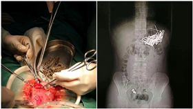 湖南,吵架,鐵釘,大頭針,包子（圖／翻攝自法制晚報）