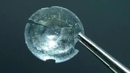 女眼睛不適開刀　隱眼竟藏裡頭28年