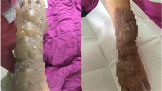 士兵遭老鳥惡整灼傷　救護車來還被擋