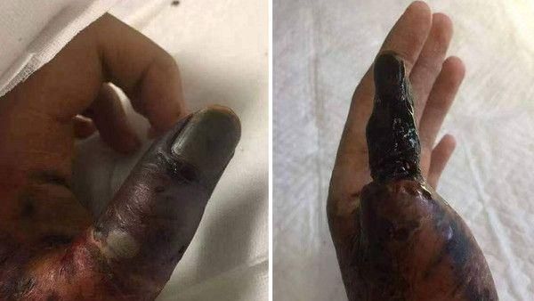 消防員遭百步蛇咬　5分萎縮如黑棗？