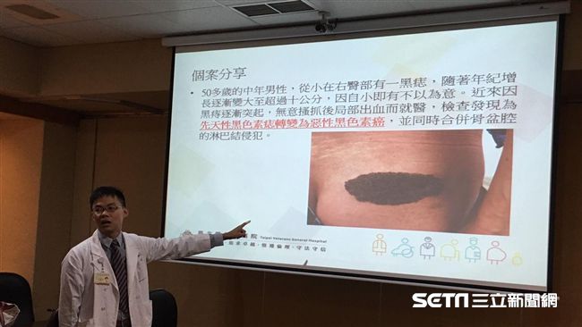 嚇！屁屁小黑痣變大抓出血　竟是癌症