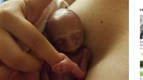 美國,懷孕,罕見疾病,愛德華氏症候群,女嬰（圖／翻攝自鏡報）