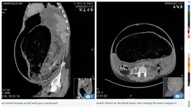 英國,便祕,巨直腸症,自閉症,腹瀉,腹痛(圖/翻攝自太陽報)