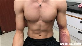 李智凱左肩疼痛腫脹僵硬，瘀傷往下沉至手肘。（圖／長庚醫院提供）