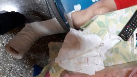 擔心太太發現　男子藏毒斷腳石膏內