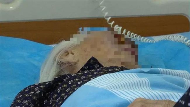 90歲婦臉潰爛發黑！就醫清出百條蛆