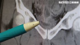 小便,放屁聲,大腸癌,血尿,泌尿道,台中慈濟醫院,泌尿科