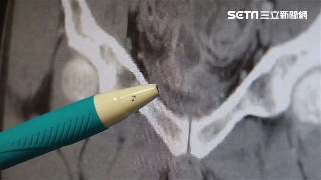 無痛血尿藏危機！6旬婦罹泌尿上皮癌