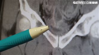 無痛血尿藏危機！6旬婦罹泌尿上皮癌