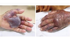 南韓71歲男子生吃海鮮，導致左手掌潰爛截肢。（圖／翻攝自the New England Journal of Medicine）