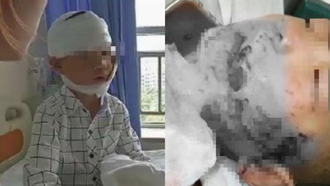 家人離開2分鐘…男童左臉遭惡犬撕開