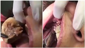 牙醫,牙結石,刷牙（圖／翻攝自臉書）