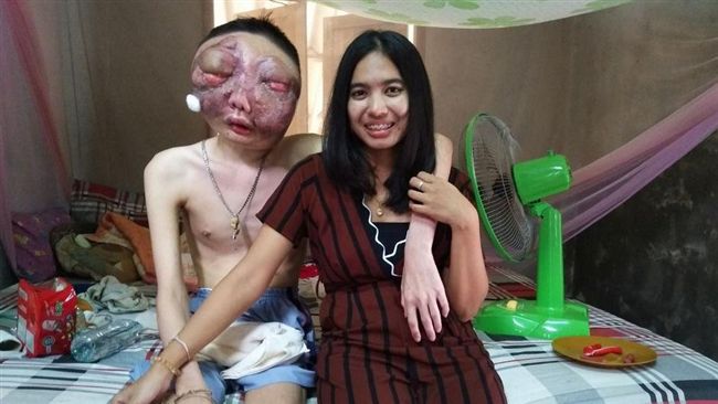 不在乎面目全非　她陪眼癌男友三年半