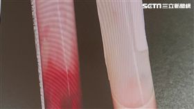 一名剛出生21天的越南何姓女嬰因高燒不退，被家人送往北榮檢查，結果發現女嬰全身的血異常黏稠，血液呈現「煉乳」色，三酸甘油脂還超過正常值的百倍。所幸女嬰經過36小時換血，成功保住性命。