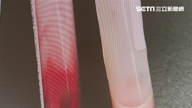 剛出生21天　女嬰全身白血如煉乳