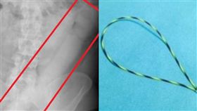 義大利男子肛門卡60公分假陽具。（圖／翻攝自每日郵報）