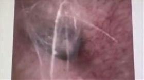 大陸遼寧一名60歲老翁某日睡醒後，發現自己的耳朵怪怪的，甚至還會聽到「敲鼓聲」，他嚇得趕緊至醫院檢查，沒想到竟發現有蜘蛛在他耳內定居結網。最後醫師用耳道清洗器注入清水，成功將蜘蛛沖出來，所幸老翁的聽力沒有受損。（圖／翻攝自微博）