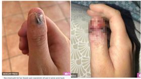 澳洲20歲女子壓力大咬指甲，卻罹患皮膚癌。（圖／翻攝自太陽報）