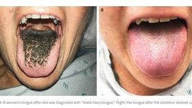 美國密蘇里州一名55歲婦人日前出了車禍，沒想到就醫治療後，她的舌頭開始變黑「長毛」，婦人嚇得趕緊就醫。醫師檢查發現，婦人罹患「黑毛舌病」（Black hairy tongue），而會出現此症狀是因為婦人服用了抗生素「米諾環素」（minocycline）。圖／翻攝自washingtonpost