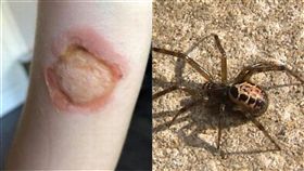 假黑寡婦,蜘蛛,傷口,皮膚,消失,抗生素,英國　組合圖／翻攝自Mirror、維基百科 https://goo.gl/ekWq34