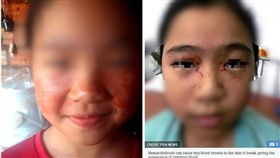 越南嘉萊省得都阿縣一名11歲女童讀書壓力大，臉部竟流出「血汗」。醫師檢查後表示，女童患上罕見的「血汗症」疾病，而「血汗症」的患病機率約為千萬分之一，目前醫師將集中處理症狀幫病人抗焦慮。（圖／翻攝自太陽報）