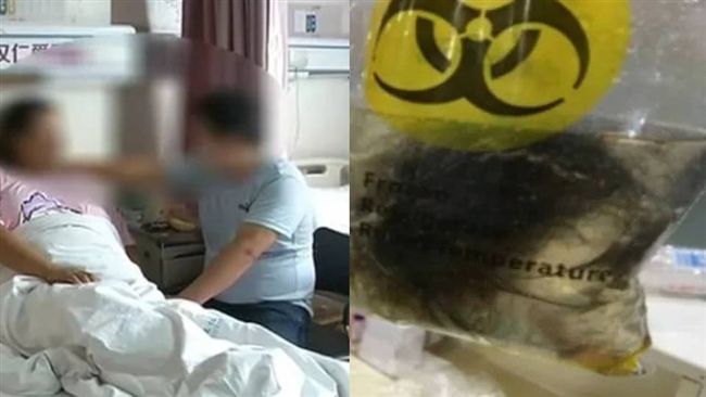 卵巢吸出毛髮＋小骨頭　真相讓她嚇壞