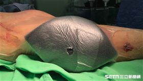 負壓傷口療法治療過程，利用泡棉隔絕傷口和感染物質。（圖非當事人／亞洲大學附屬醫院提供）