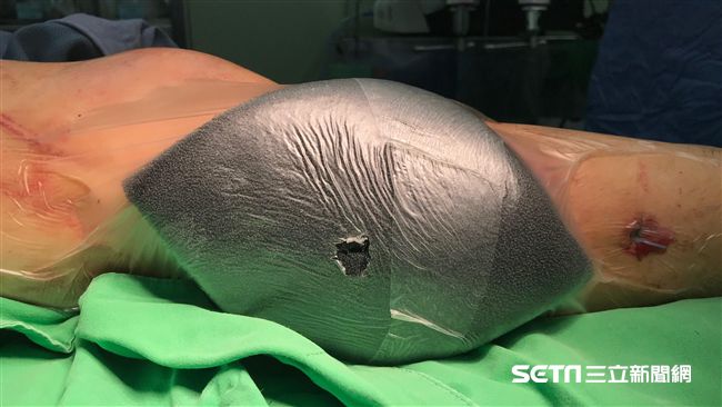 她「犁田」腿皮膚毀　靠這招助癒合