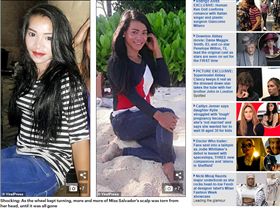 ▲薩爾瓦多得頭皮和頭皮遭扯掉。（圖／翻攝自《每日郵報》）
https://goo.gl/AuJNu1