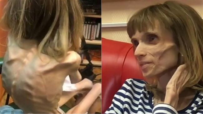 醫嘲厭食女：可演喪屍　原因被讚翻