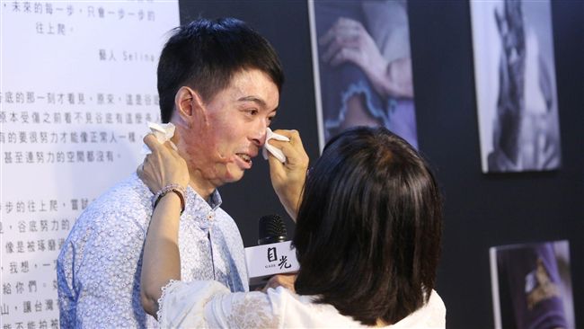 氣爆傷者：別用目光，讓他靈魂再灼傷