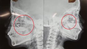  印度女童拿別針挖鼻孔／YouTube