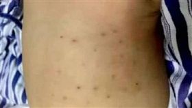 中國湖北襄陽,男嬰,蜂窩,刺傷,民俗療法,誤信偏方