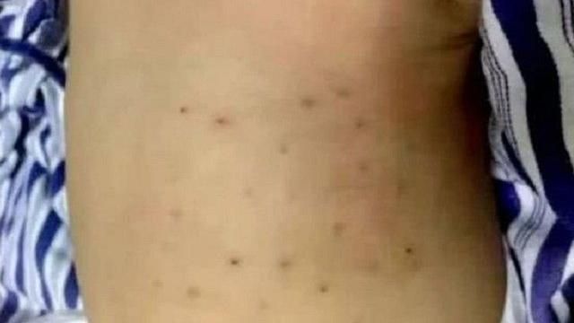 月餘男嬰夜哭不睡　被父母刺成蜂窩