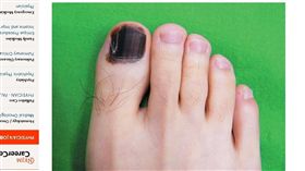 黑色素癌,腳趾甲整片變黑（圖／翻攝自新英格蘭醫學雜誌（NEJM）官網）