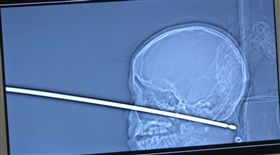 ▲坎寧安頭顱遭烤肉叉刺穿。（圖／翻攝自堪薩斯大學醫院Youtube）
https://www.youtube.com/watch?v=D_BFQsEU6is