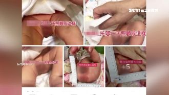 新生兒陰囊潰瘍　家長怒控托嬰疏失！