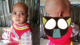 腫瘤,女嬰,疾病,巴基斯坦,脖子,頸後,診斷,脊髓,腦積水,　圖／翻攝自Metro https://wp.me/p2Vnvc-xxgk