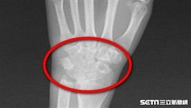 手腕關節因為類風濕反覆發炎而磨損僵硬變形。（圖／台北慈濟醫院提供）