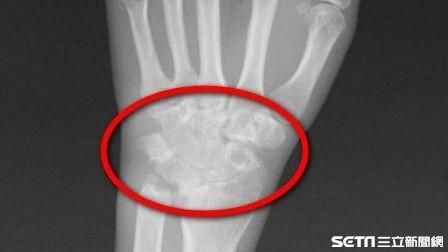 她認真教鋼琴　竟導致右手3條肌腱斷
