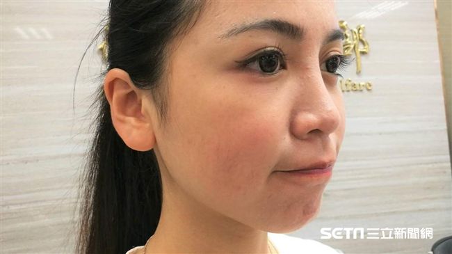 唇部乾就習慣舔抿一下？恐害嘴唇生病