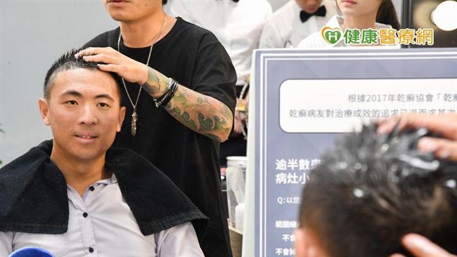 有頭皮屑當心！這病逾半數從頭開始
